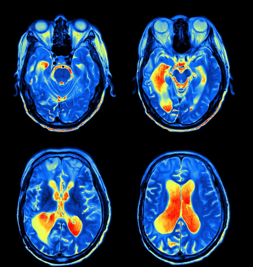 IRM (avec traitement de couleur) du cerveau et des yeux