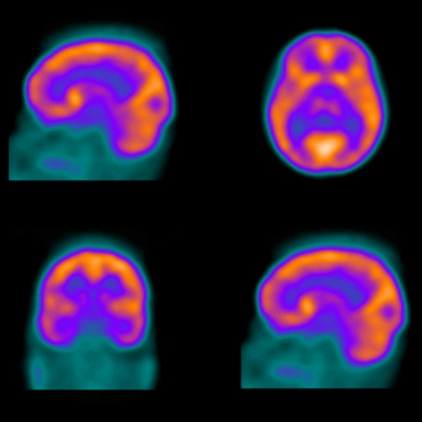 Image médicale du cerveau réalisée à l’aide du technétium-99m