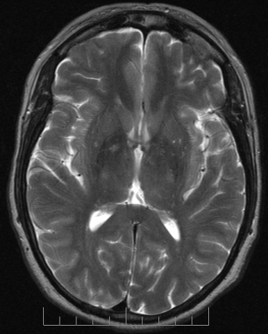 Image IRM d’un cerveau humain 