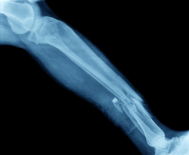 Radiographie d'une jambe cassée 