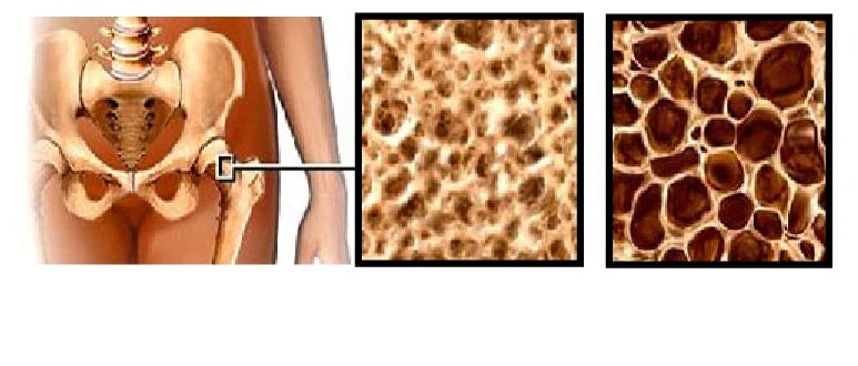 Le rectangle de gauche montre un os spongieux sain, et celui de droite, un os spongieux affaibli.