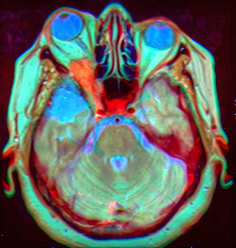 Image par résonance magnétique artificiellement colorée montrant le cerveau, les nerfs optiques et les yeux 