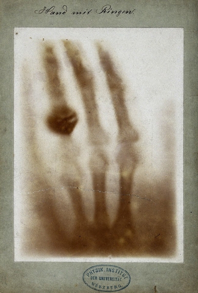 The first medical x-ray