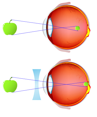 Diagram of myopia and lens correction with a biconcave lens