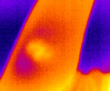 Thermal image of arm with burn