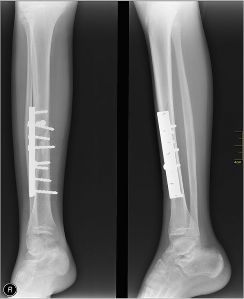 X-ray showing a person with metal pins and bars used to support broken leg bones/Radiographie montrant des tiges métalliques qui soutiennent les os d’une jambe fracturée