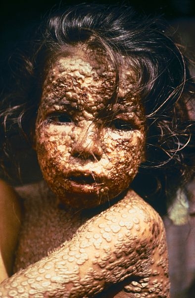 Enfant atteint de variole au Bangladesh, 1977